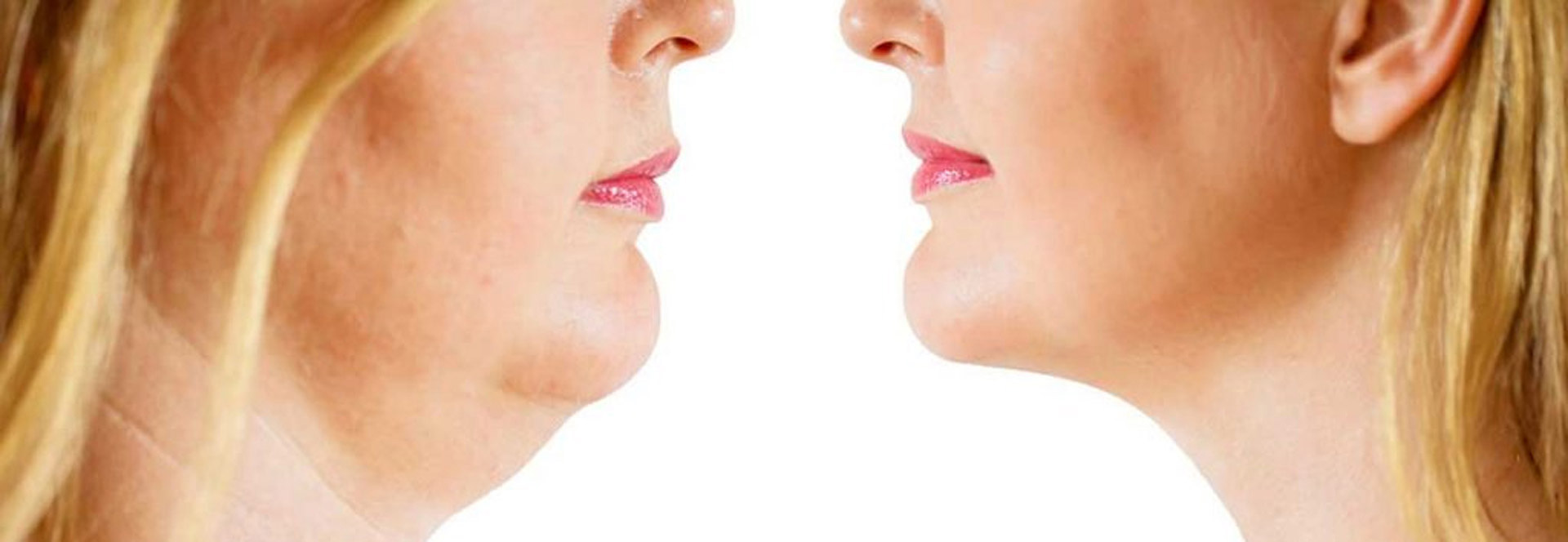 Aqualyx patient after fat removal from chin