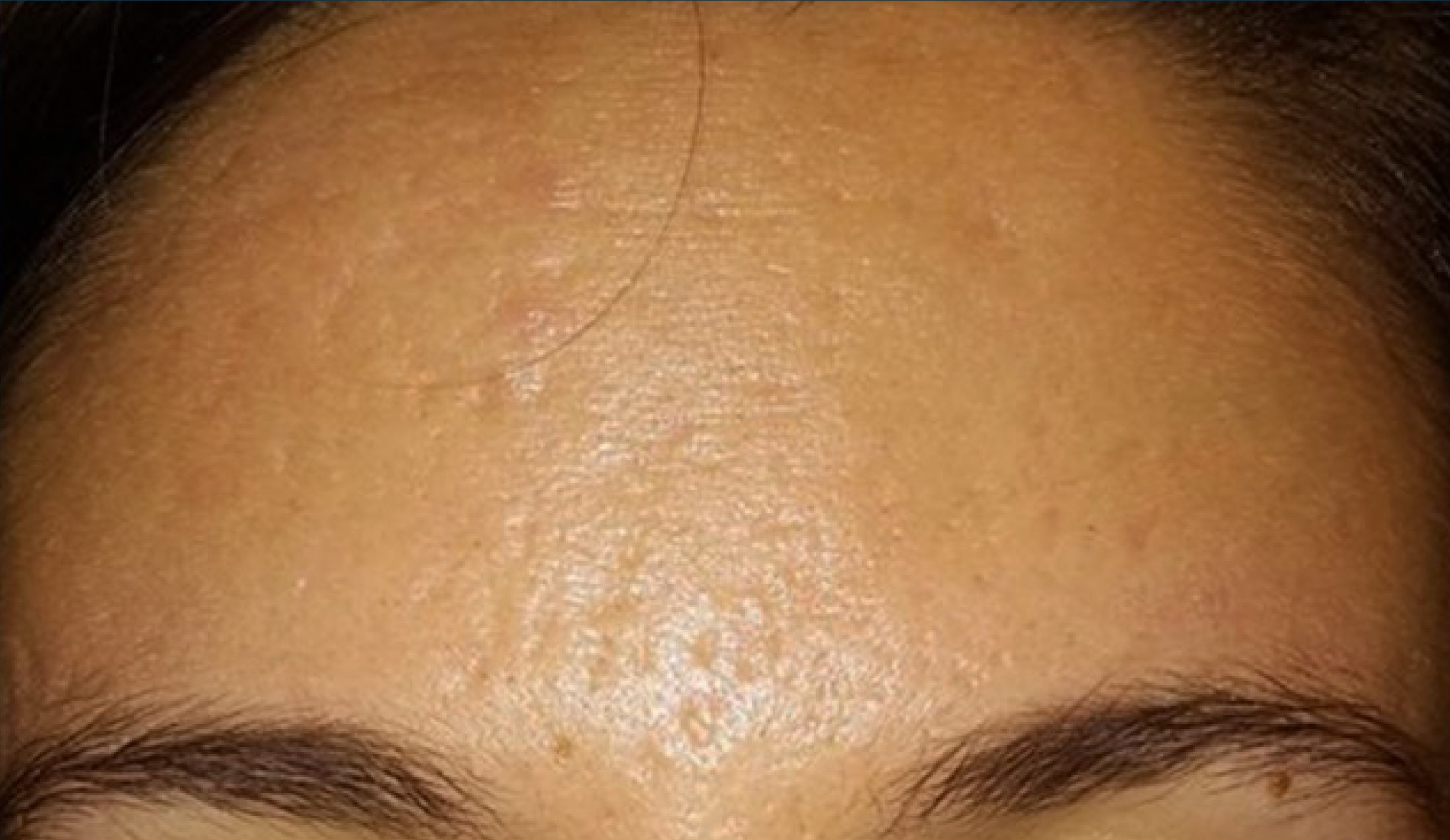SkinPen Acne Treatment - Before